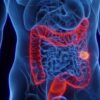SUS adota novo exame para detectar câncer de intestino; MA já registra 191 casos em 2026