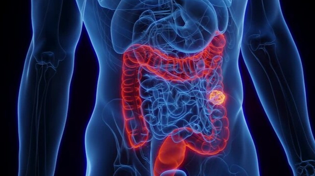SUS adota novo exame para detectar câncer de intestino; MA já registra 191 casos em 2026